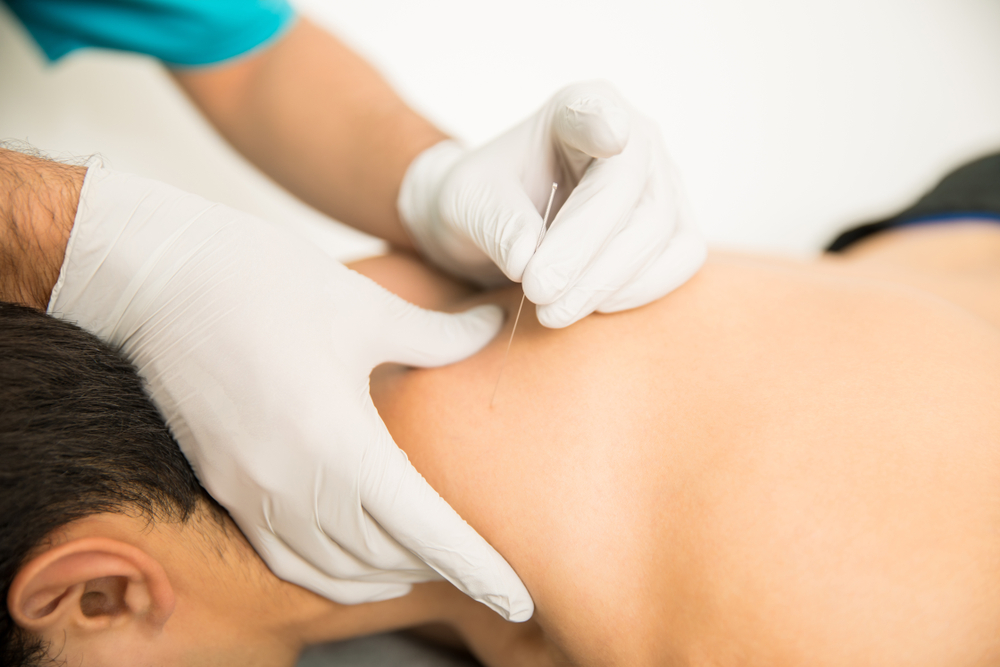 Closeup of shirtless man receiving dry needling therapy from doctor in clinic