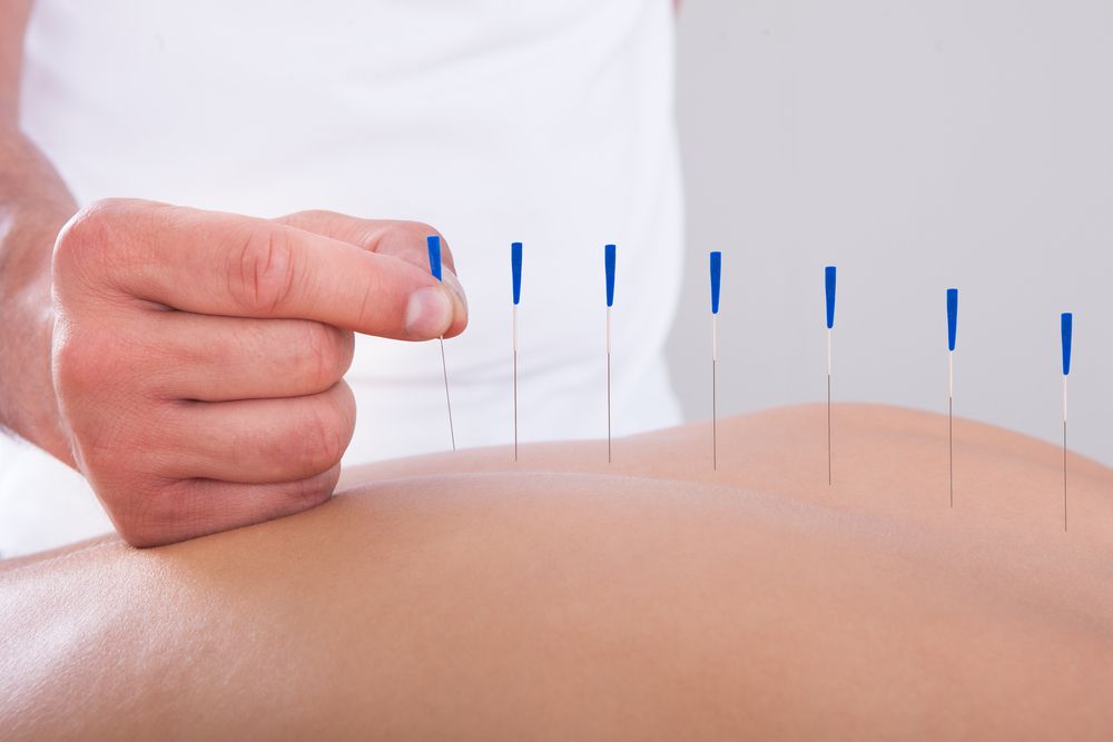 Young Beautiful Woman In An Acupuncture Therapy