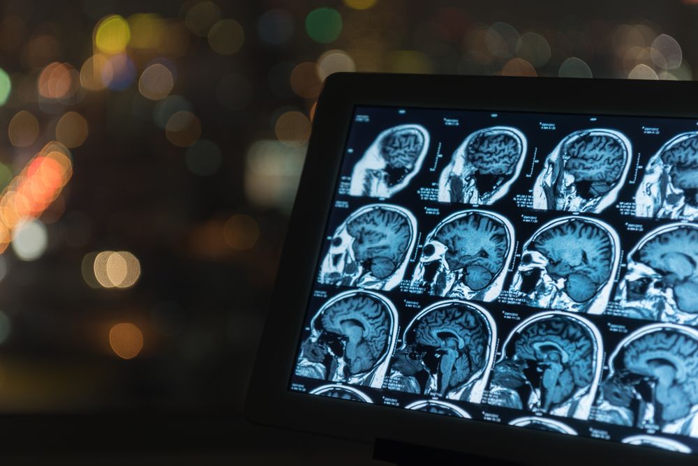 magnetic resonance image, mri scan of the brain on tablet screen computer.