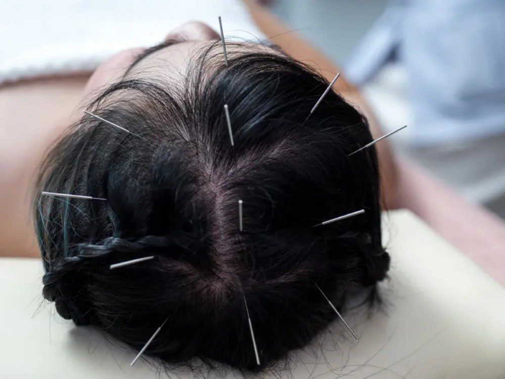 Neuroacupuncture-scalp-denver-colorado-stroke-concussion-tbi-parkinsons-ms-