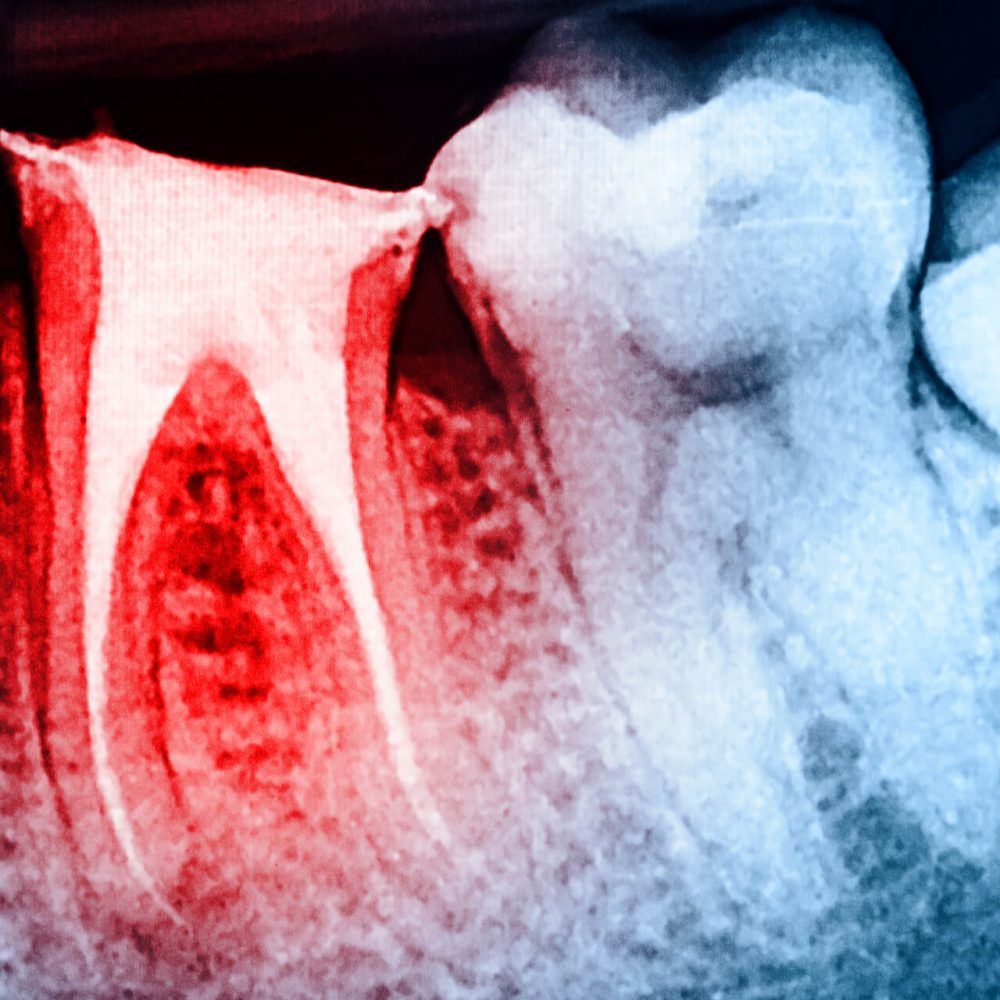 Full Obturation of Root Canal Systems On Teeth X-Ray