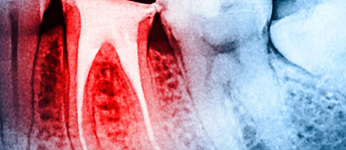 Full Obturation of Root Canal Systems On Teeth X-Ray