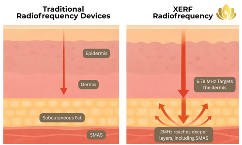 XERF skin tightening diagram comparing traditional RF vs XERF
