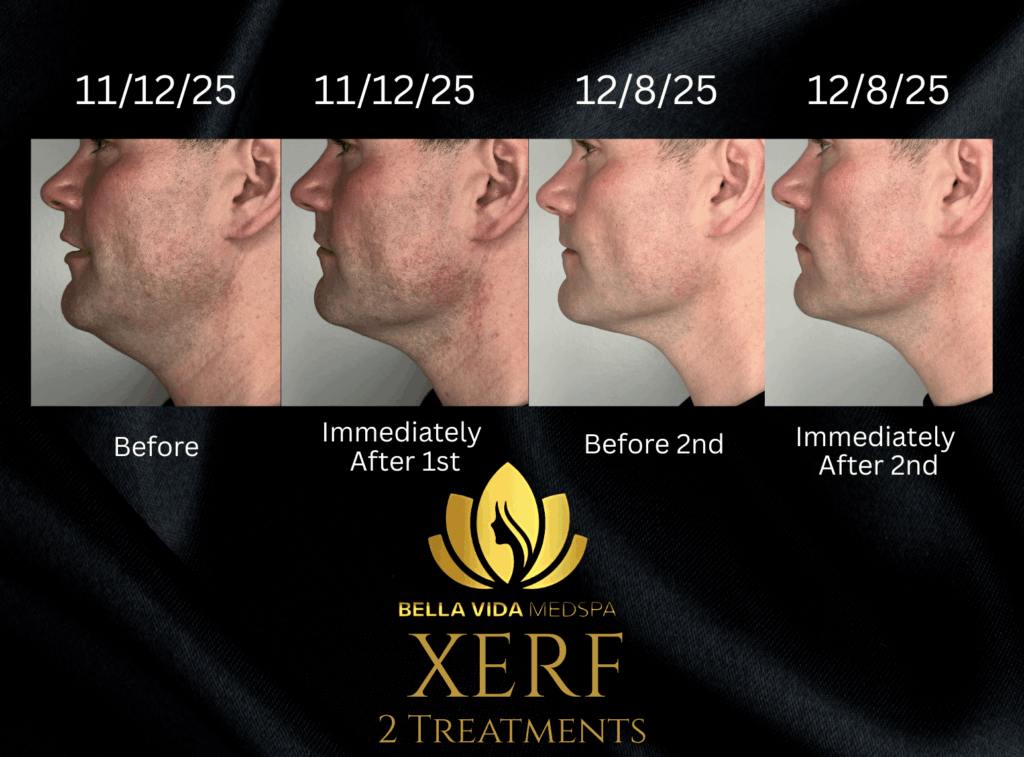 XERF skin tightening before-and-after