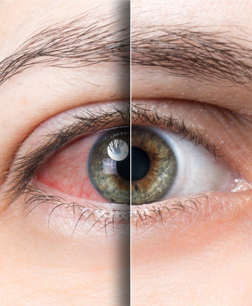 Red eye before and after treatment