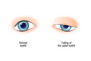 Ptosis is a drooping of the upper eyelid