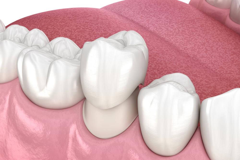Preparated premolar tooth and dental crown placement
