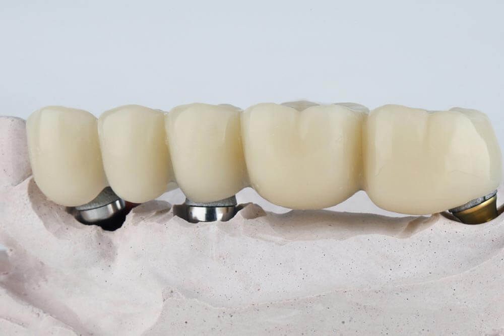 dental bridge prosthesis