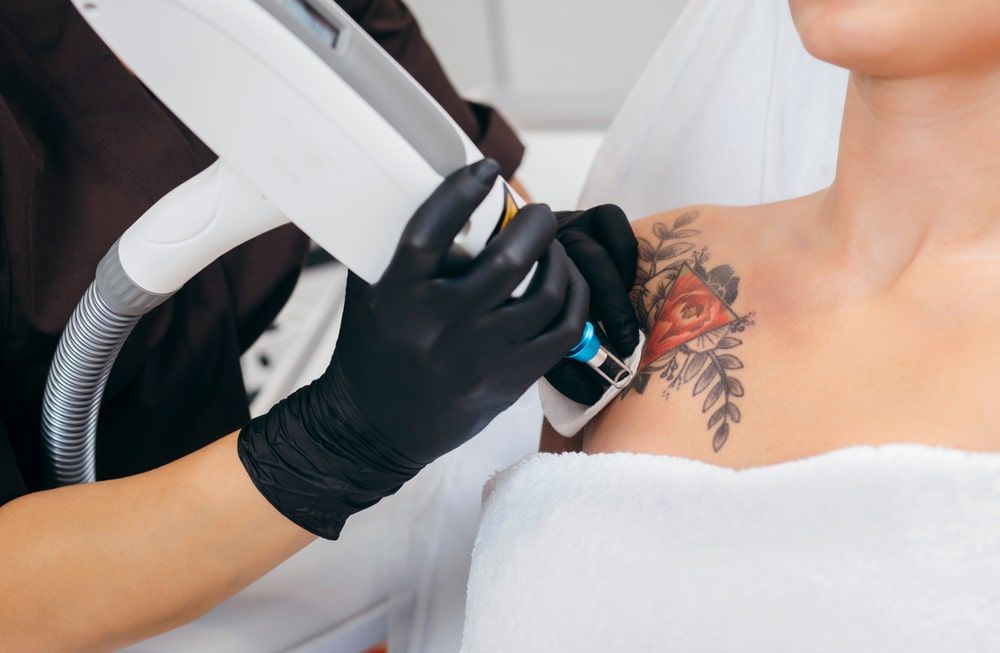 Laser tattoo removal from shoulder