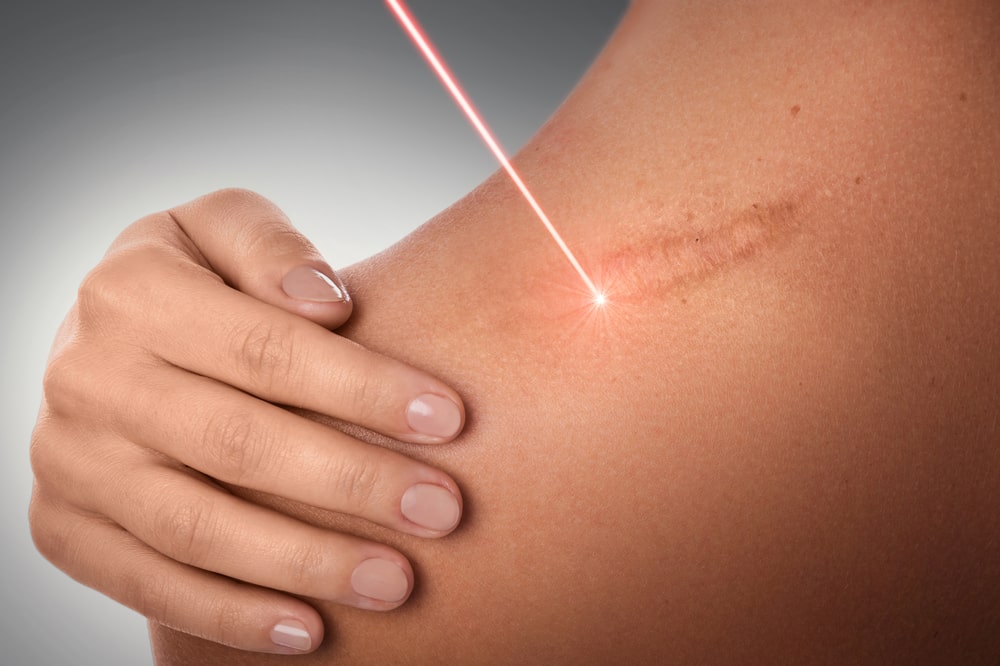 Female shoulder and laser beam during scar removal treatment