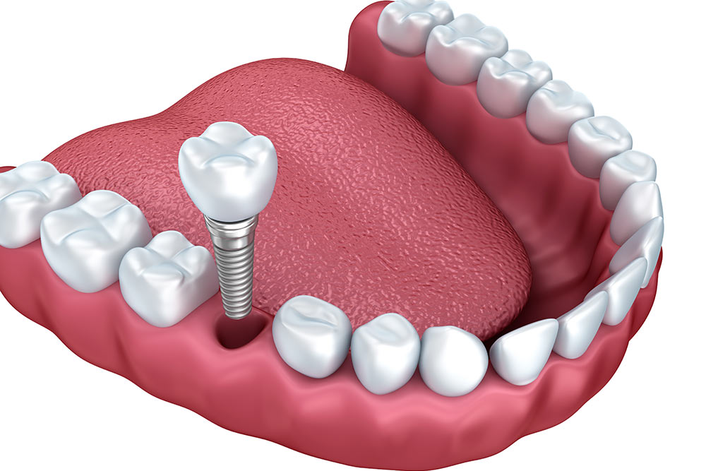 Dental Implants in Winter Haven, FL | Smiles of Winter Haven