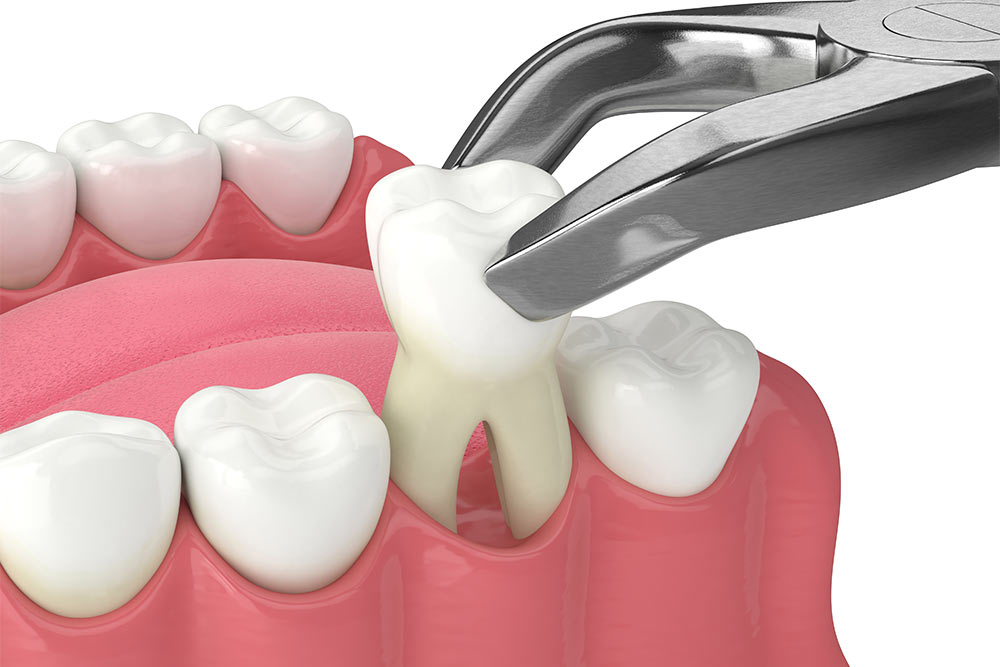 Tooth Extraction in Winter Haven, FL | Smiles of Winter Haven