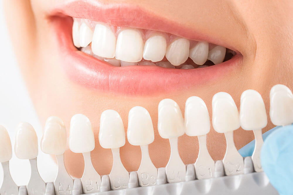 Teeth Whitening in Winter Haven, FL