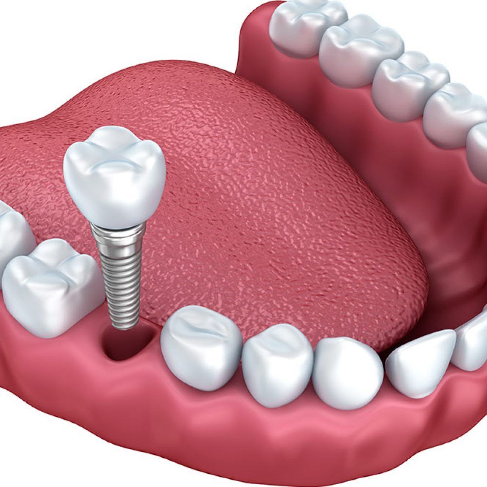 Dental Implants in Winter Haven, FL | Smiles of Winter Haven