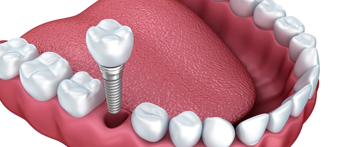 Dental Implants in Winter Haven, FL | Smiles of Winter Haven