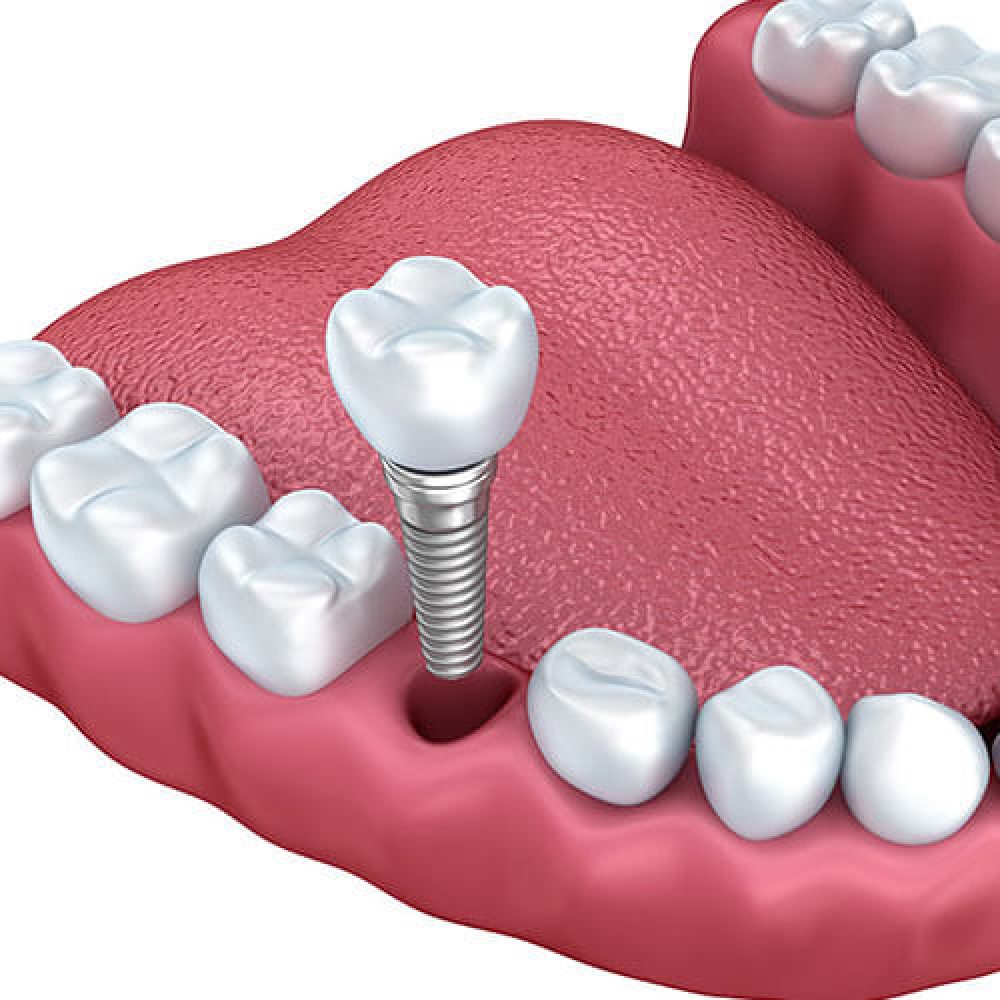 Dental Implants in Winter Haven, FL | Smiles of Winter Haven