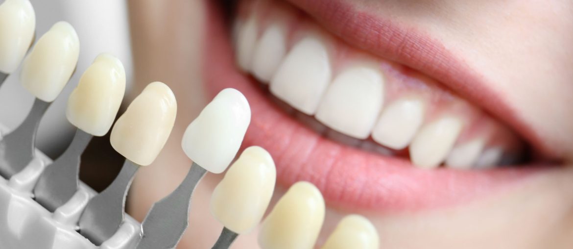 Closeup of smile with tooth shade board in front of it