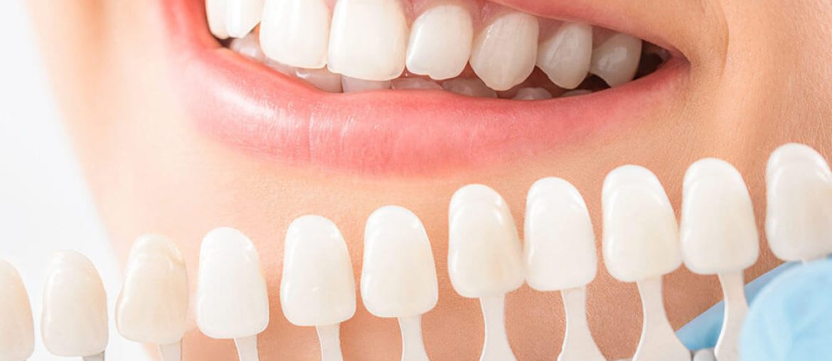 Teeth Whitening in Winter Haven, FL