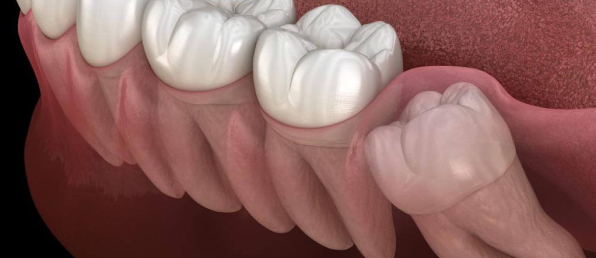 Wisdom tooth with impaction at molar tooth