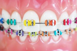 orthodontic model and dentist tool - demonstration teeth model of multi color of orthodontic bracket or brace