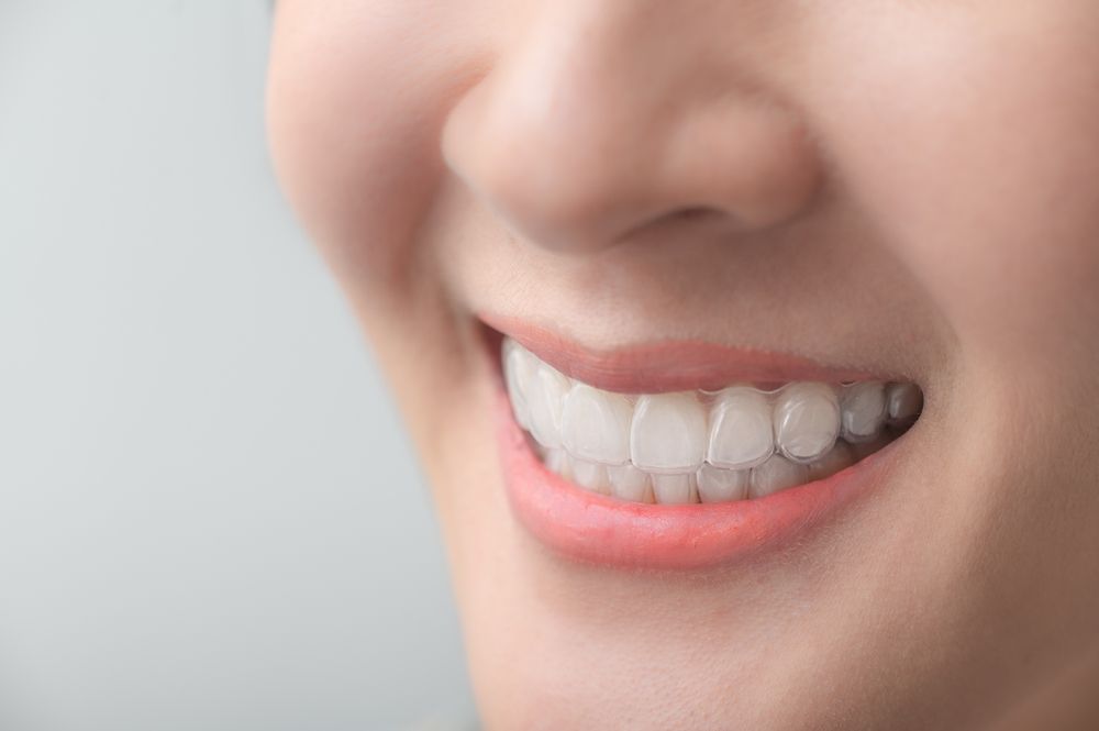 Best Invisalign Treatment  Lawrenceville, Loganville, Morrow, Stone  Mountain, GA