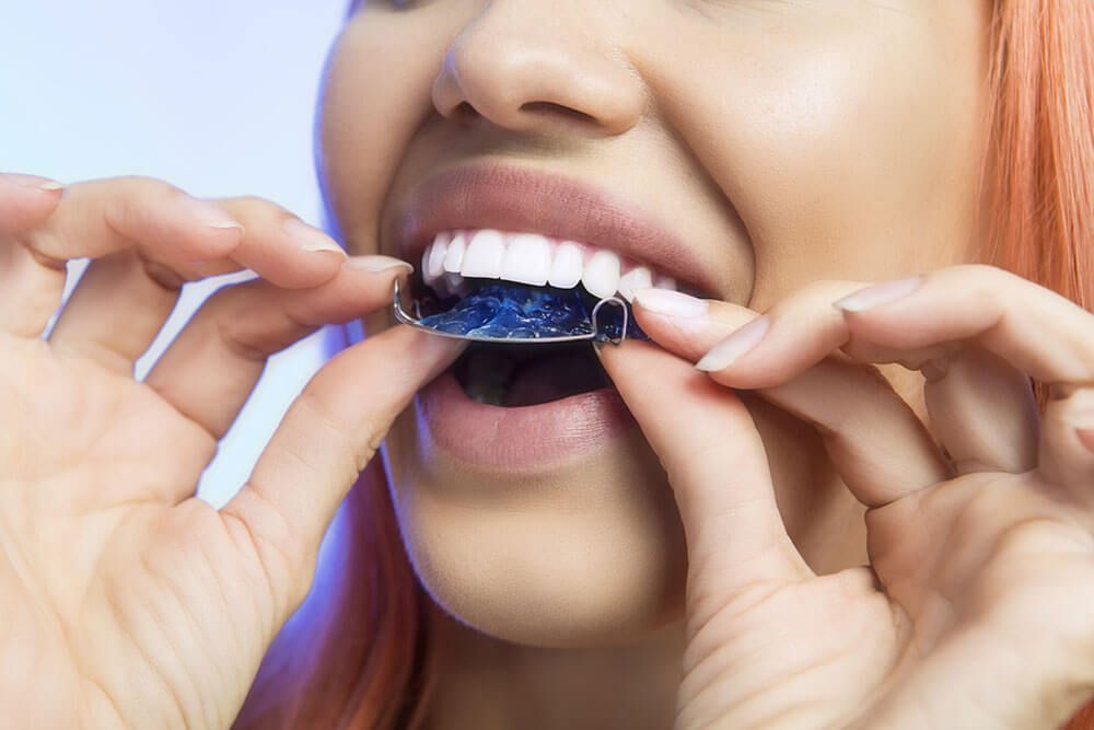 Smiling Girl Holding blue Retainer, Braces for Teeth