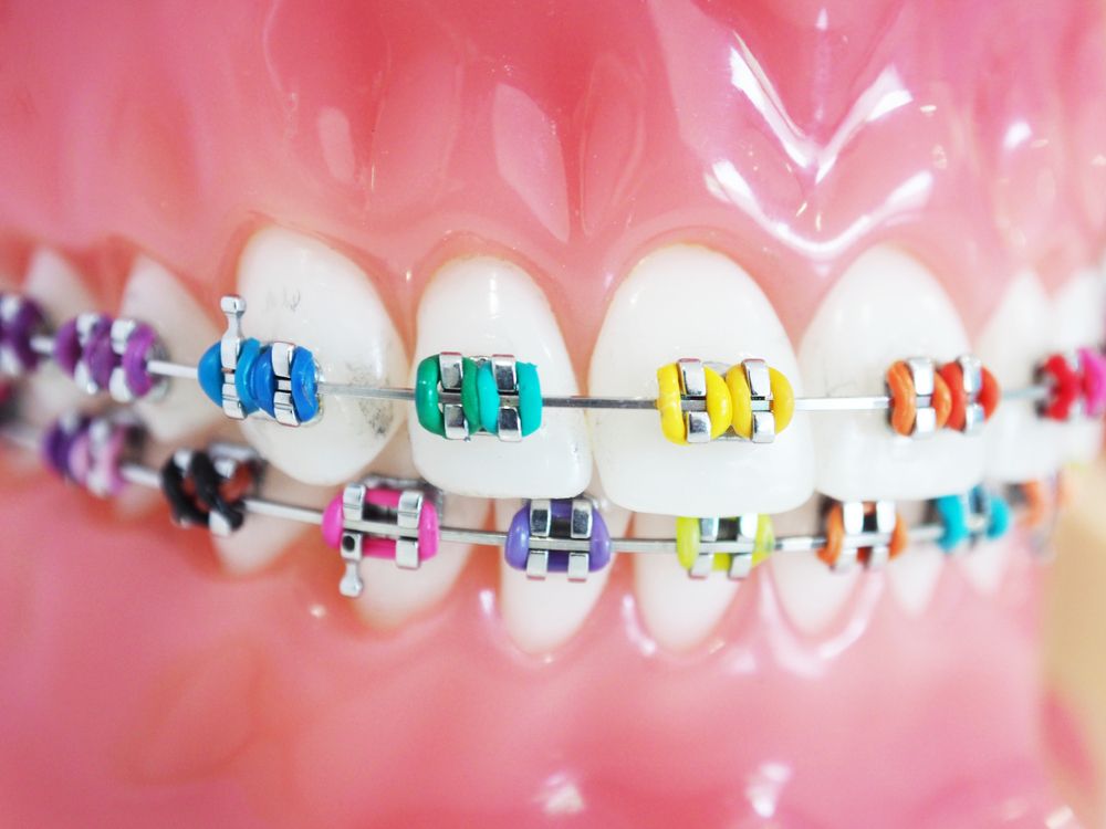 Types of Braces: Traditional Metal Braces