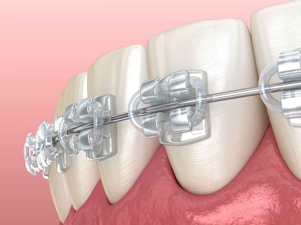 Jaw And Clear Braces 3d Illustration