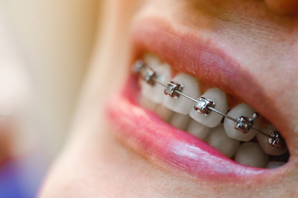 A person smiling with self-ligating braces