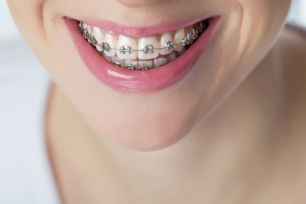 A picture of someone smiling with braces regarding Orthodontic FAQs