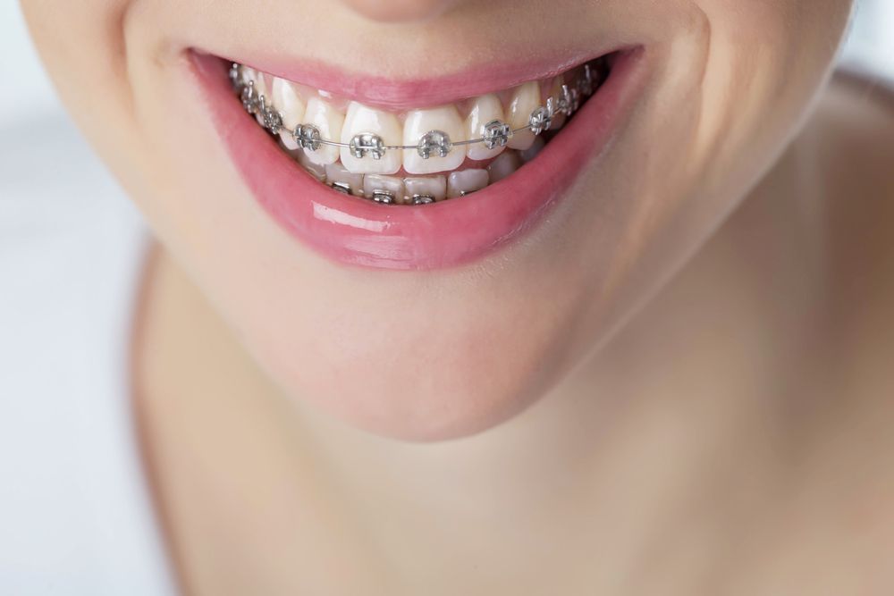A picture of someone smiling with braces regarding Orthodontic FAQs