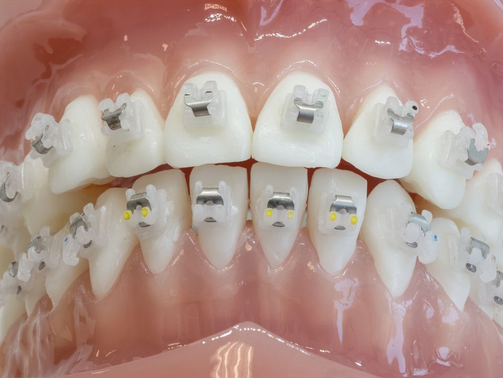 Orthodontic Dental Model