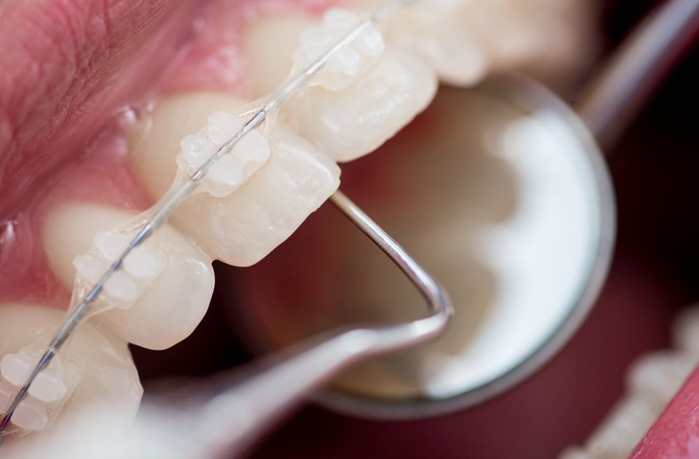 Orthodontist checking on ceramic braces