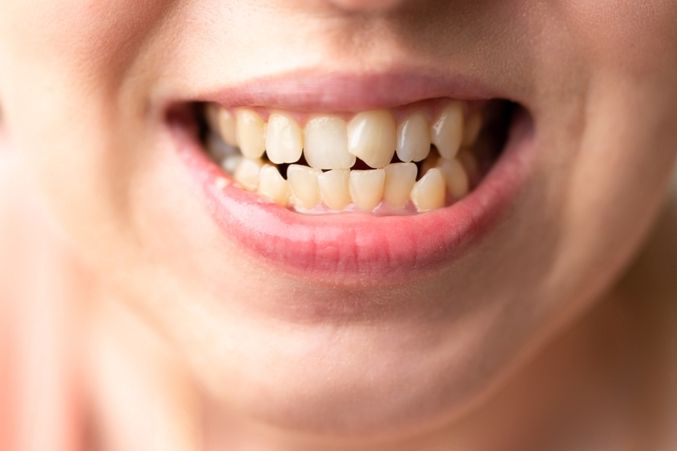 A teenager with crooked teeth that can benefit of Invisalign Treatment for Teens