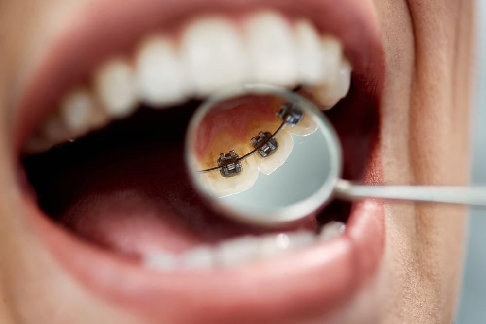 Close-up of female patient having check-up of dental braces on the back side of her teeth at dental clinic.