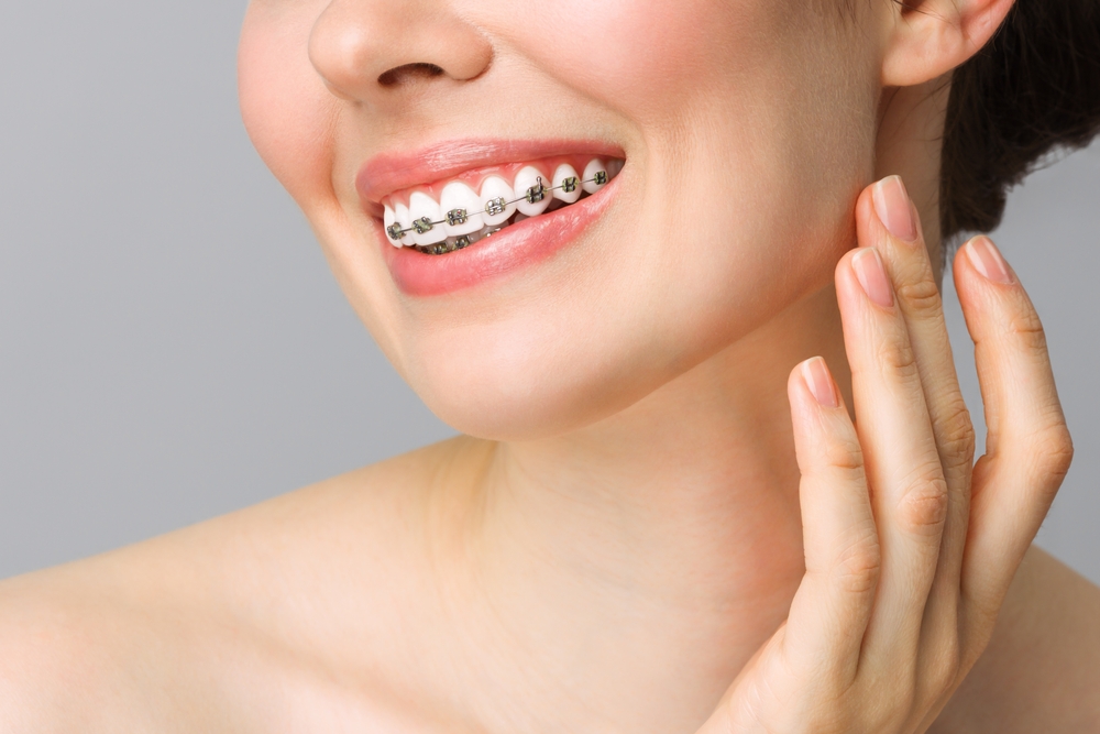 Orthodontic Dental Care Concept. Woman Healthy Smile close up