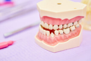 Malocclusion on a denture Model in a dental clinic as an example in orthodontics