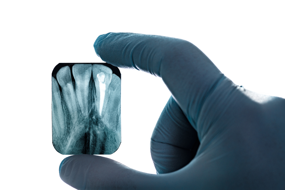Radiography imaging teeth upper canines root canal hand in glove laboratory film isolated