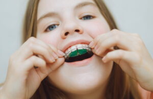 Dental plate. Expansion of the jaw in a child. There is not enough space for molars