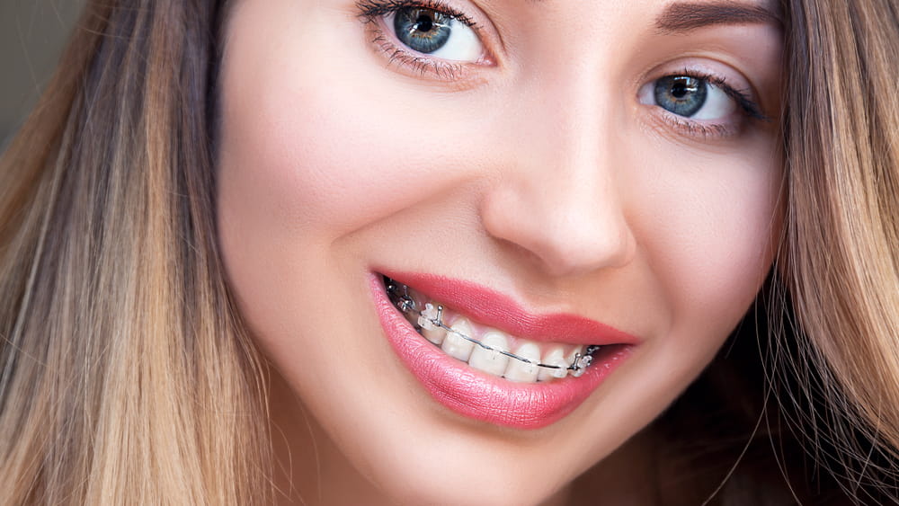 Close up Ceramic and Metal Braces on Teeth. Beautiful Female Smile with Self-ligating Braces. Orthodontic Treatment.