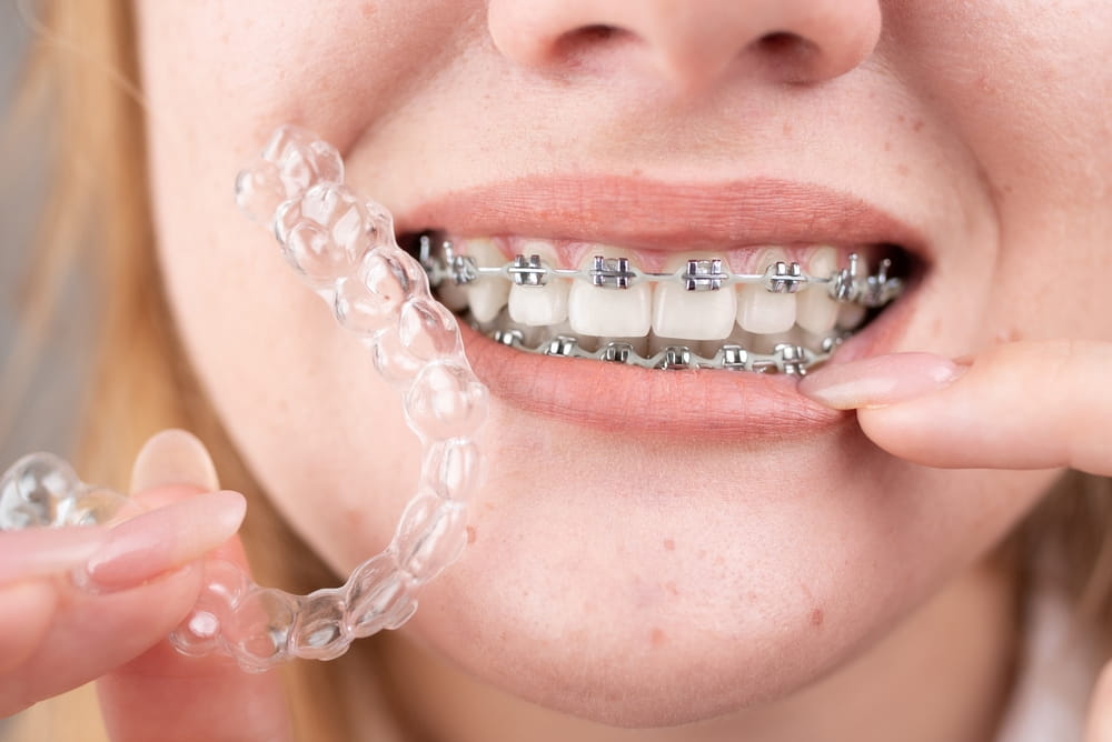 Dental care.Smiling happy girl with braces on her teeth holds aligners in her hands and shows the difference between them