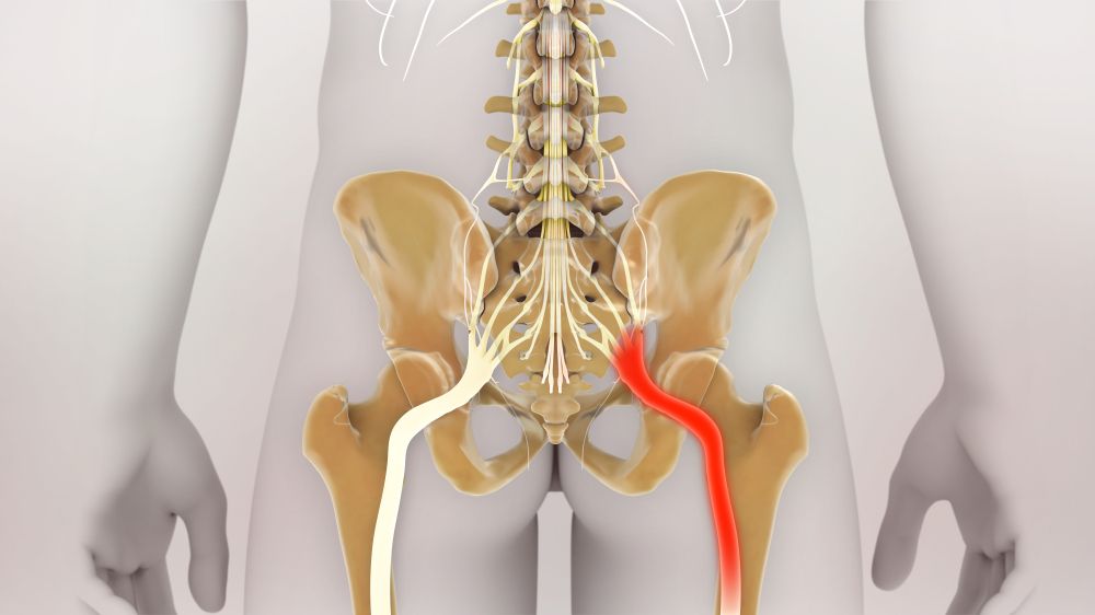 3D Rendering Sciatic Nerve Pain