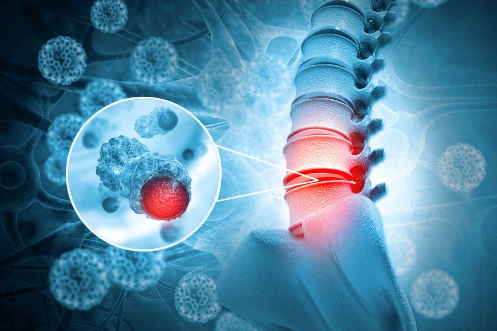 Spine cancer or spinal tumor disease.3d illustration