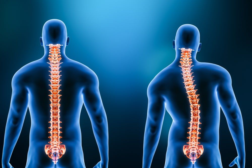 Comparison between normal backbone and scoliosis curvature of the spine with male model from back