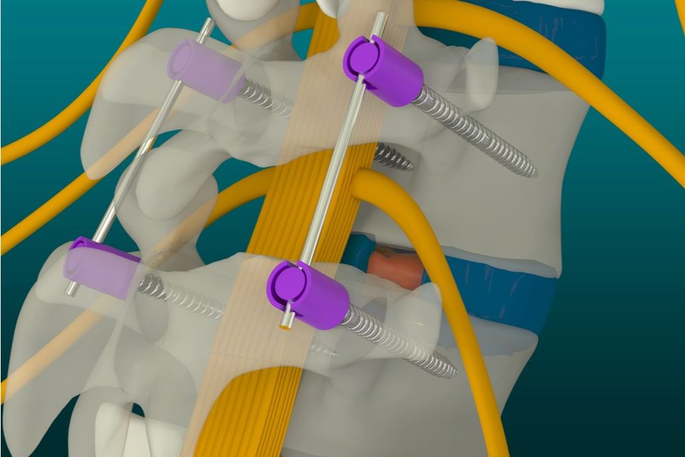 3d illustration, spinal fusion surgery, disc herniation surgery