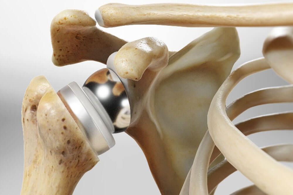 Total Hip Replacement Surgery in Omaha, NE