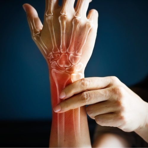 Acute pain in a woman wrist