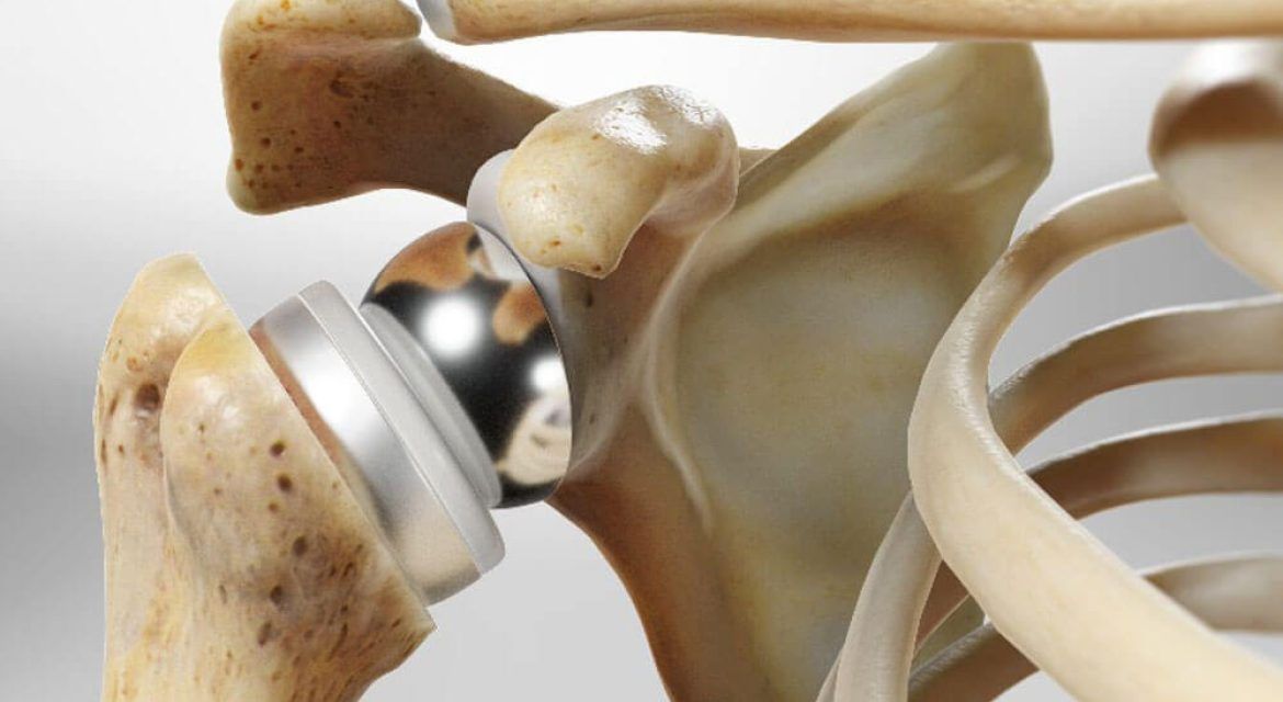 Medically accurate illustration of a shoulder replacement
