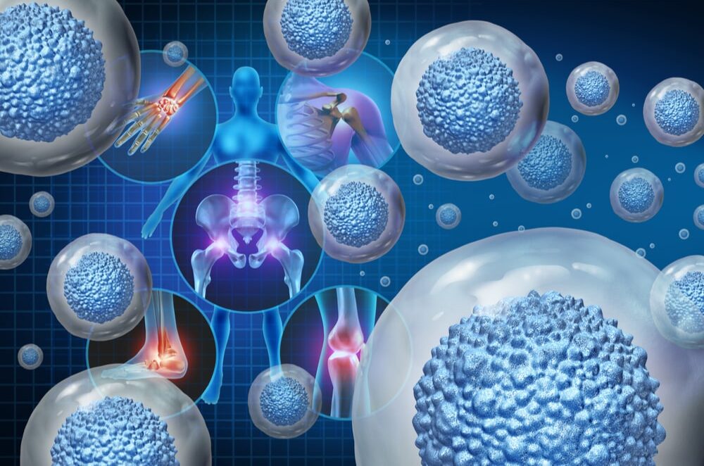 Stem cell therapy and treatment for painful joints illustration