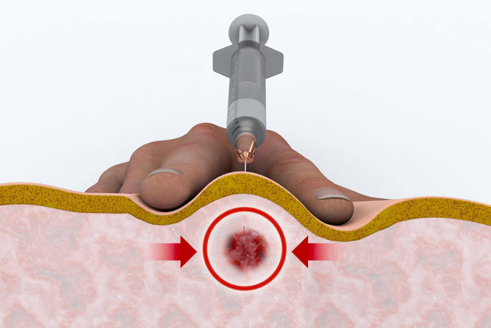 A trigger point injection is an outpatient procedure designed to reduce